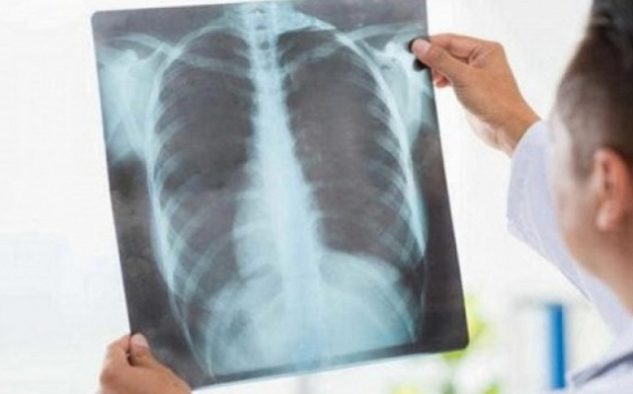 Резкий скачок числа больных пневмонией зафиксирован в Казахстане
